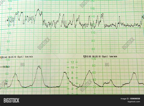 How to Tell Contractions on Monitor: A Symphony of Wires and Whispers